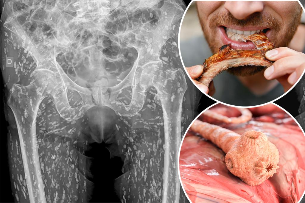 X-rays show tapeworm-infested body - the gruesome way he got it